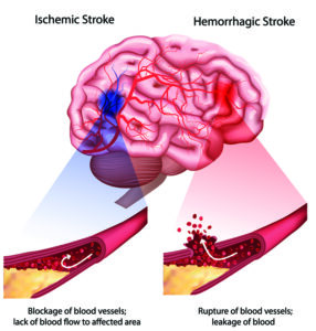 graphic showing types of stroke